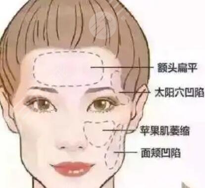 自体脂肪填充后十天图