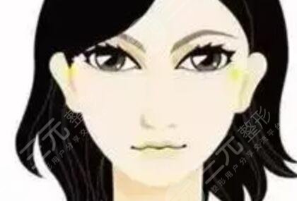 眼窝填充术后10天