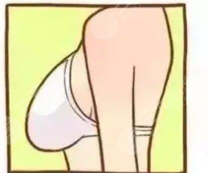 丰胸前后的图片对比