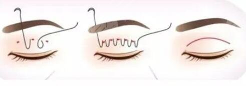 卢建建双眼皮修复价格表，双眼皮修复案例很美呀！