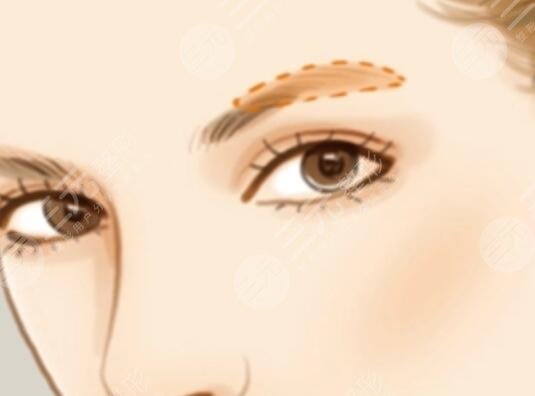 激光洗眉术后6天