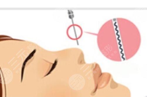 什么样子的鼻子适合做韩式隆鼻术