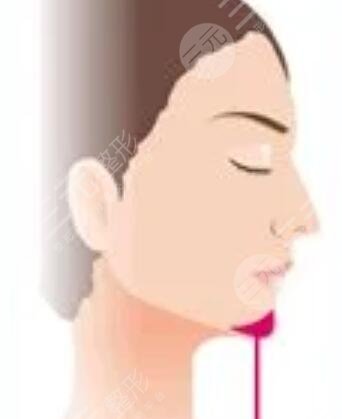 四川娇点姜宇绿下颌角截骨怎么样？手术过程恢复记录！