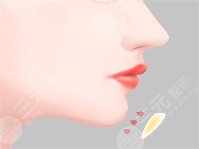 四川娇点姜宇绿下颌角截骨手术之后的一个月