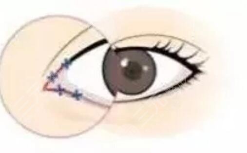 埋线双眼皮修复过程图