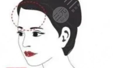 额头玻尿酸填充前后图