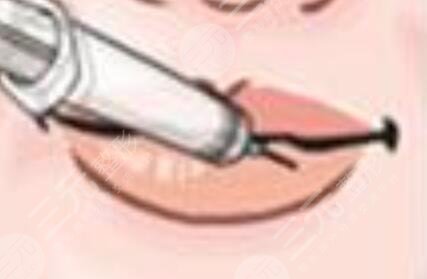 纹唇一到七天恢复过程参考：嘟嘟唇好看诱人~