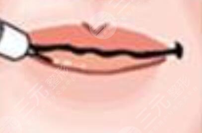 纹唇前的状况