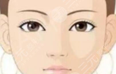 7mm双眼皮术前