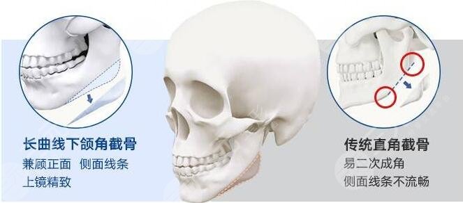 磨骨瘦脸术后护理：