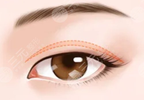 激光洗眉一到七天图片