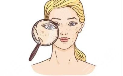 医大一院美容科激光科祛斑案例