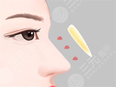 鼻子医生王志坚案例参考术前