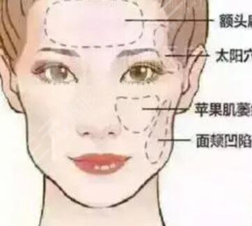 北京八大处整形医院面部脂肪填充案例