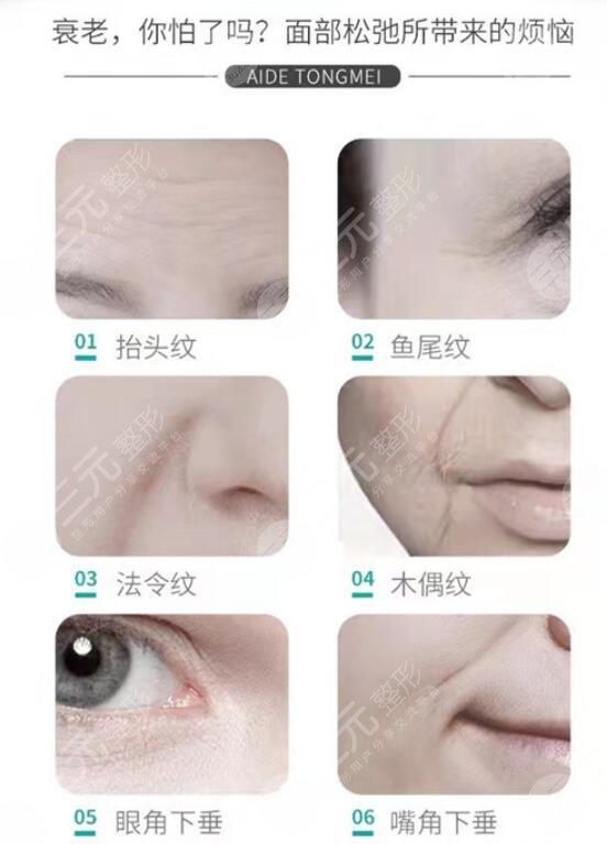 拉皮手术