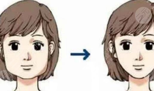 磨骨手术的过程