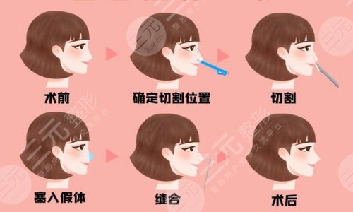隆鼻