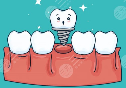 种植牙多少钱一颗2021价格表芜湖地区1万一颗贵不贵价格影响因素