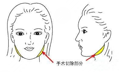 磨下颌角