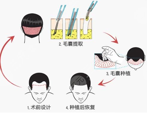 头顶加密种植