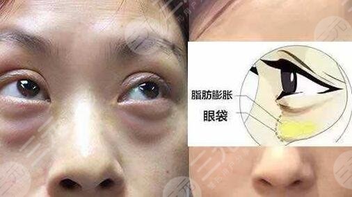去眼袋手术有后遗症吗?