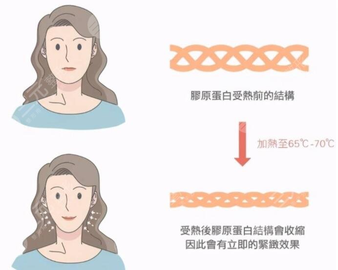  激光去除法令纹