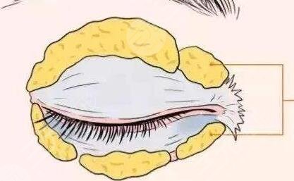 北医三院去眼袋案例