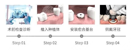 种植牙的手术原理是什么?