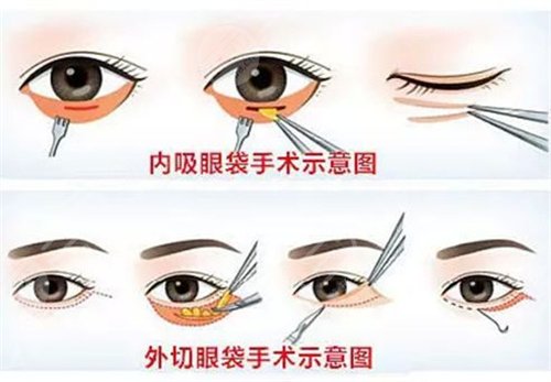 四川省人民医院杜丽平医生案例图 去眼袋哪个医生技术好