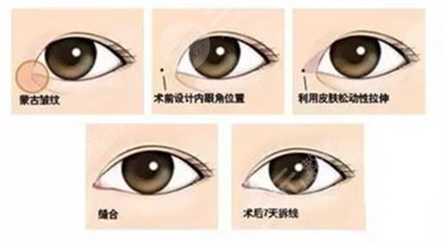 郭亮医生双眼皮案例