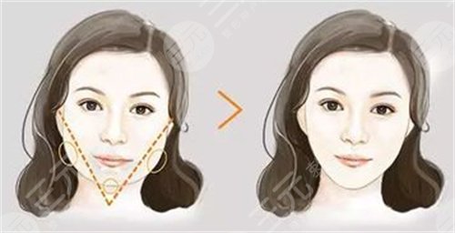 黄磊医生的注射瘦脸案例