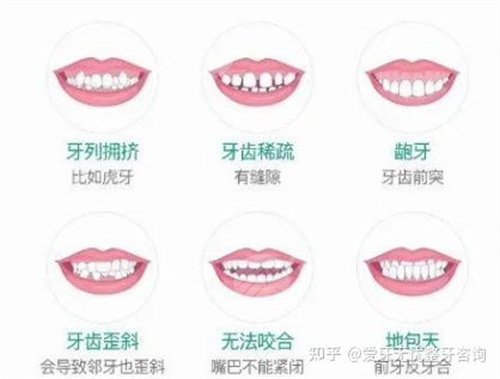 隐形矫正案例