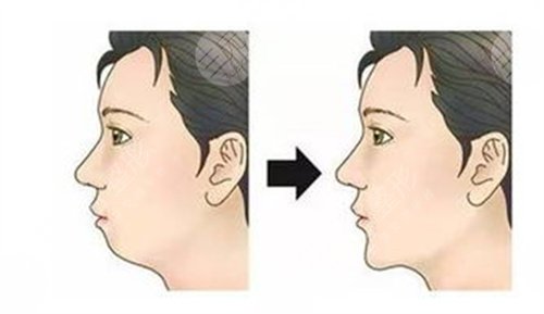 正畸骨性龅牙案例