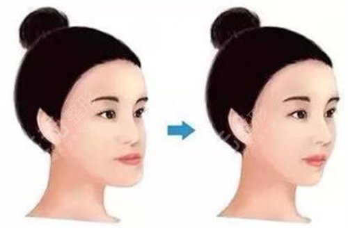 正畸骨性龅牙案例