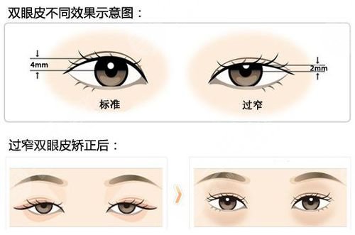 孔伟医生的双眼皮手术术后