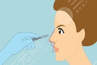 上海九院王涛医生隆鼻案例