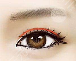 双眼皮手术后22天