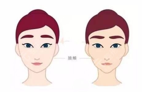 北京玉之光王明利做自体脂肪填充怎么样