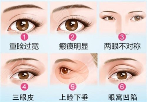 南京中大医院双眼皮案例图