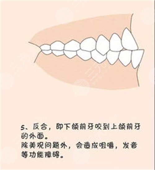 牙齿矫正经典案例