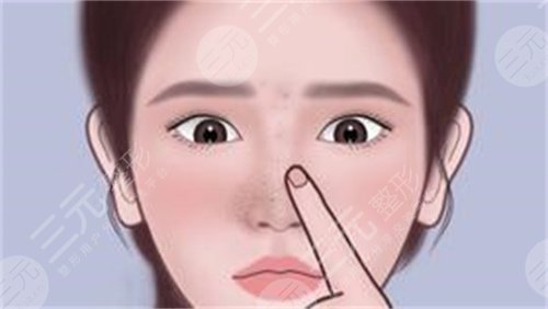 隆鼻案例图