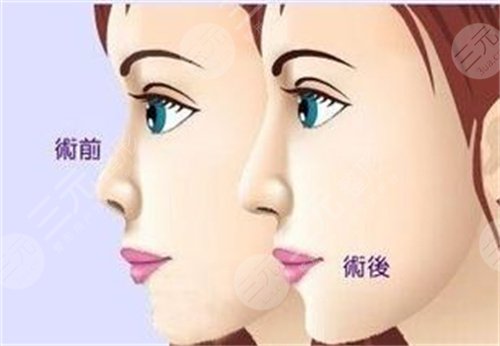 隆鼻案例图
