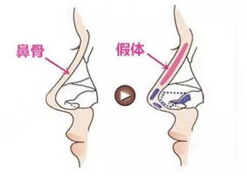 隆鼻案例图
