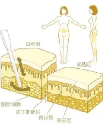 冯斌整形吸脂案例