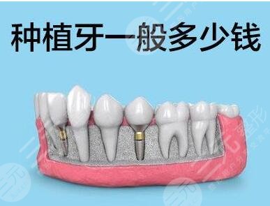 种植牙多少钱一颗2021价格表天津