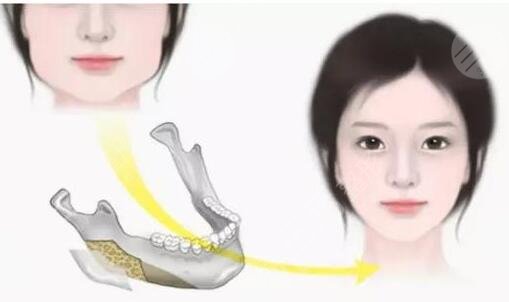 磨骨手术对比照片