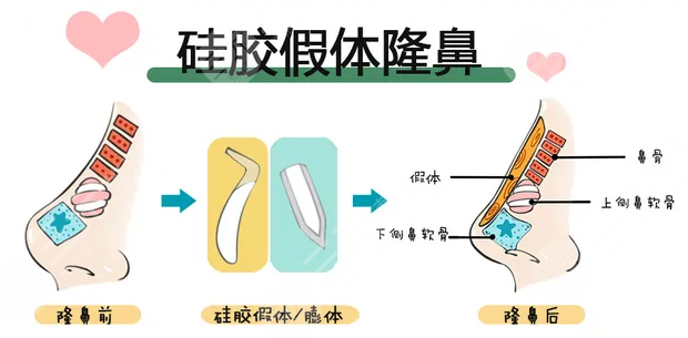 重庆华美李超医生隆鼻术后一周