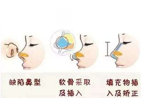 重庆华美李超医生隆鼻术后5周