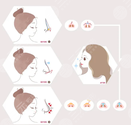 华美李超做鼻子后49天