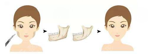 黄旭培在磨骨改脸型手术过程